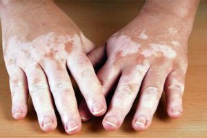 vitiligo5